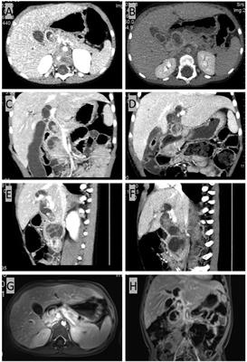 Case Report: Robotic pylorus-preserving pancreatoduodenectomy for periampullary rhabdomyosarcoma in a 3-year-old patient